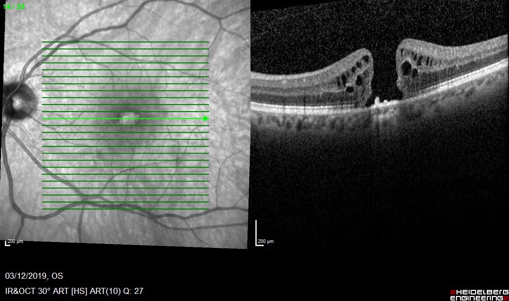 Macular hole in London