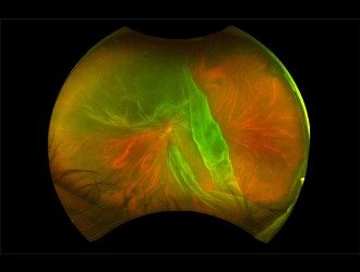 Expert Retinal Detachment Surgery in London