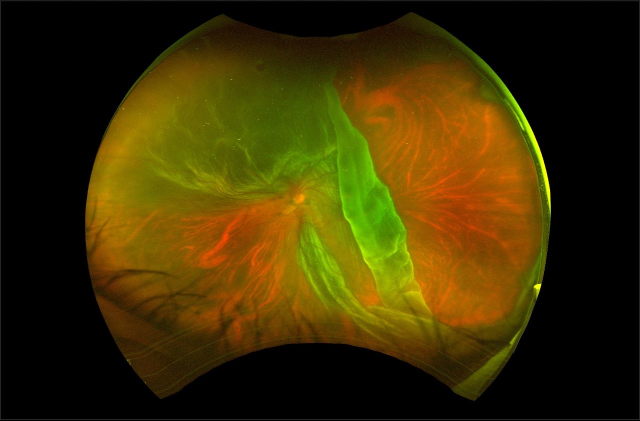 Surgical Retina | Surgery for Retinal Detachment