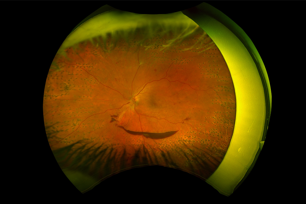 Complications of diabetic retinopathy