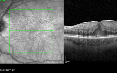 Epiretinal Membrane (ERM): Causes, Symptoms, and Treatment